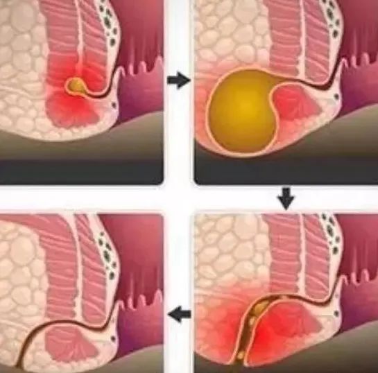 肛瘺最新治療探索，前沿技術(shù)與方法的深度研究